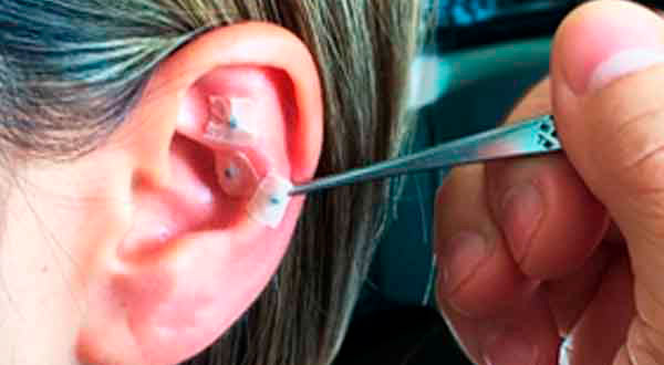Imagem Tecnica de Auriculoterapia